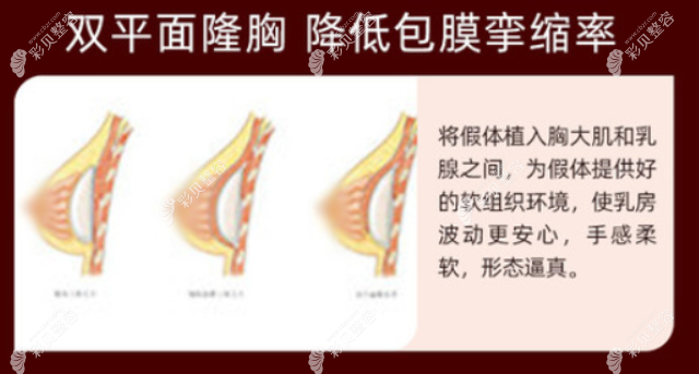 双平面假体隆胸的优势