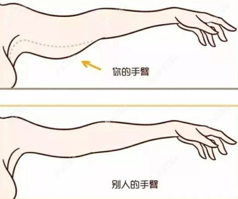 手臂吸脂多久能变细?亲身分享做手臂吸脂后变细的时间过程