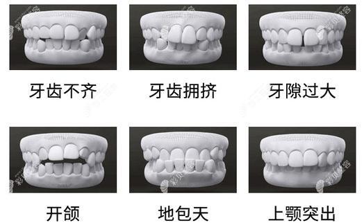 常熟安澜口腔矫牙适应症