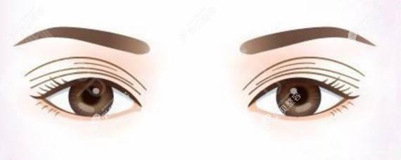双眼皮宽改窄出现三眼皮怎么办,宽变窄后有两个痕迹太丑了