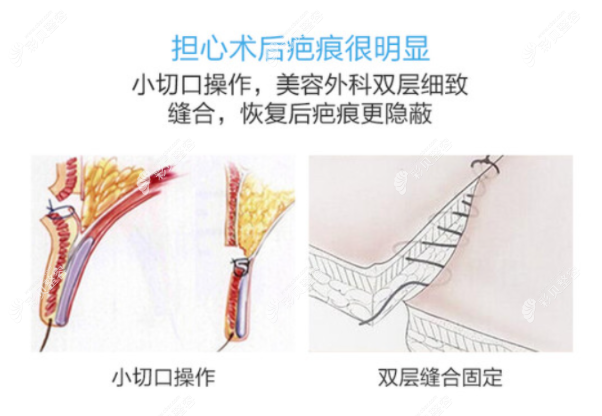 昆山玥美做双眼皮怎么样