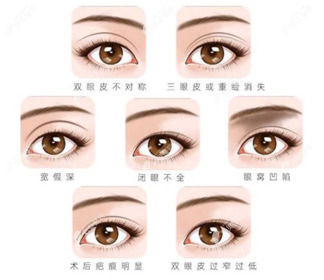 双眼皮失败的症状有哪些