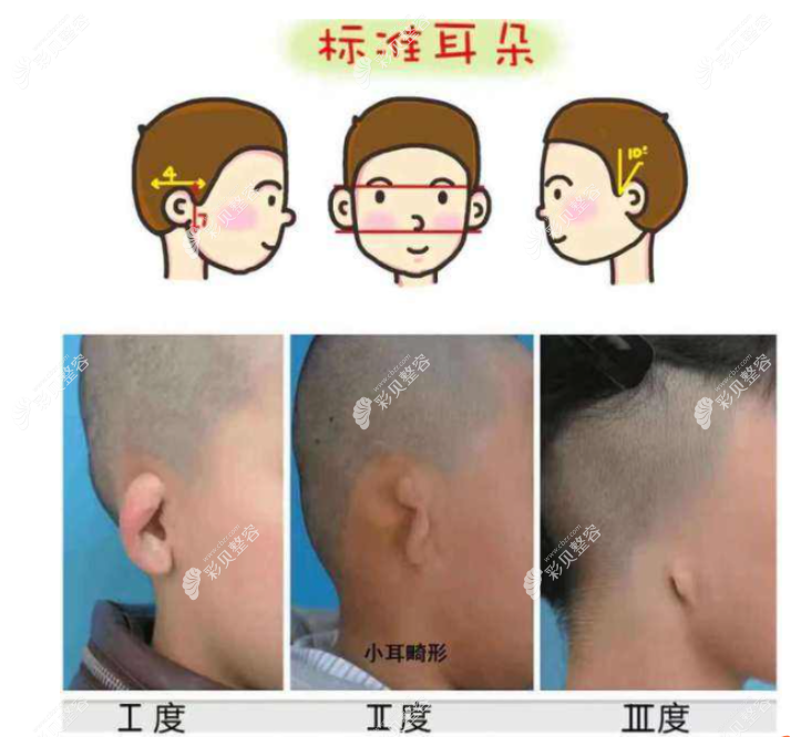 什么样的情况下可以做耳再造手术