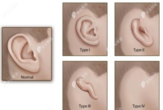 什么样的情况下需要做耳再造手术