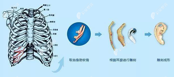 取肋软骨做耳再造手术怎么样