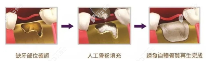 种植牙植骨的流程