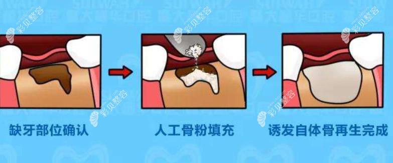 种植牙植入骨粉的过程