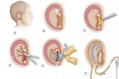 小耳再造手术做完二期必须做三期吗,三期很久没做有影响吗