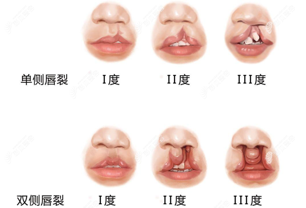 单侧唇腭裂和双侧唇腭裂的程度表
