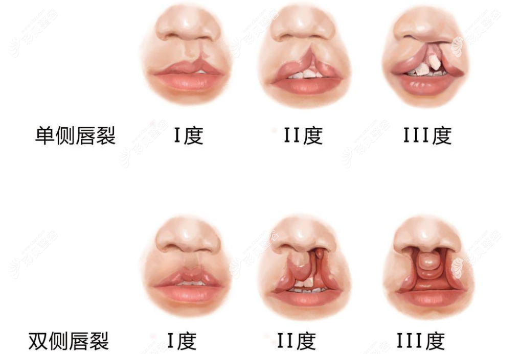 22年先天性唇腭裂还能做手术修复吗,修复完能像正常人吗