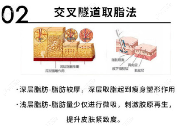 深圳美莱医院做大腿抽脂技术——交叉吸脂法