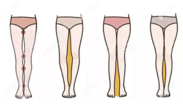 深圳美莱抽脂双腿前后对比