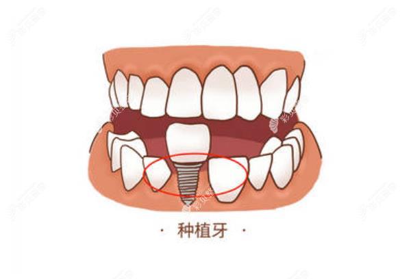 牙周炎种牙需要植入骨粉吗