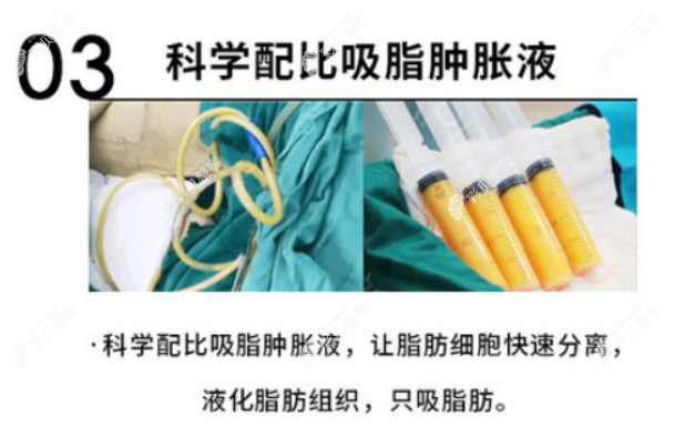 深圳美莱做大腿抽脂的优势