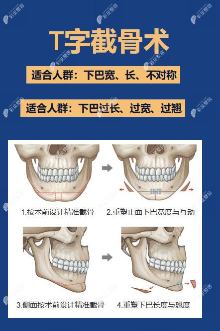 下巴t形截骨操作步骤