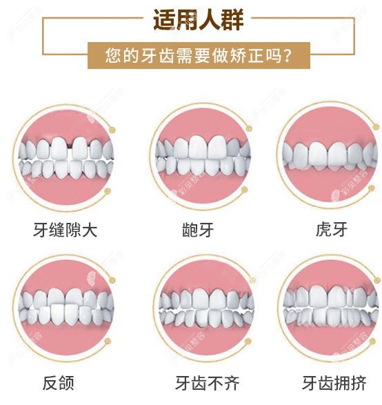 朝阳牙博士能正畸的牙齿类型