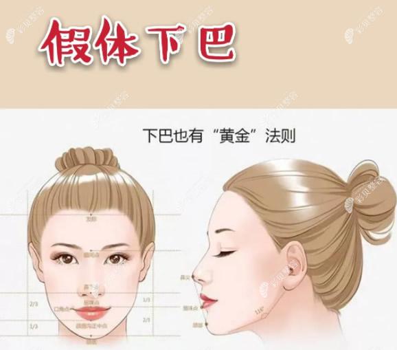 假体垫下巴怎么样