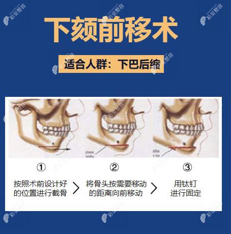 下巴截骨前移是怎么做的