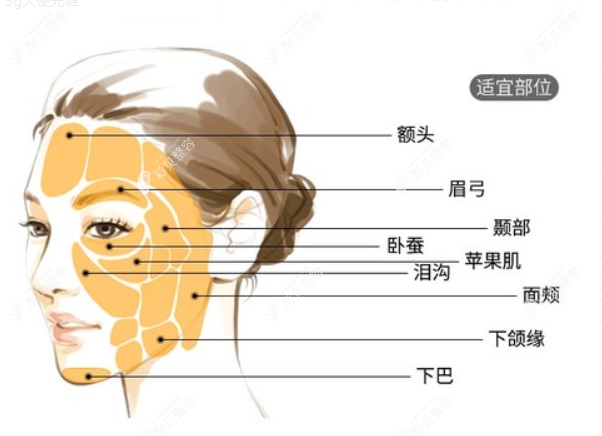 深圳美莱脂肪填充医生可填充全脸的部位