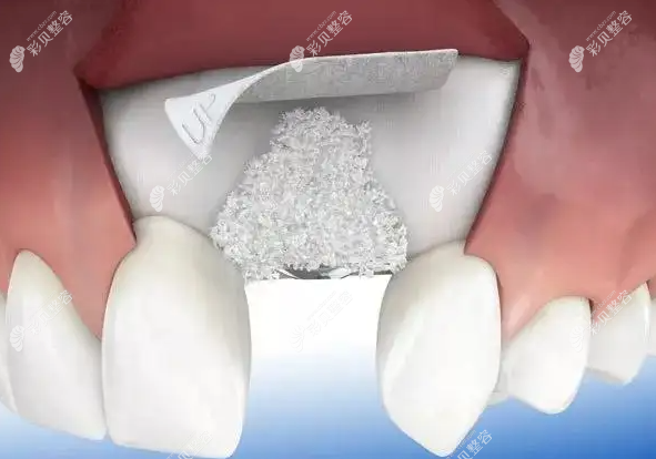 种植牙骨粉骨膜图片