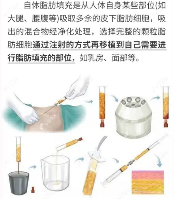 深圳美莱脂肪填充原理