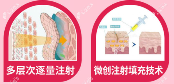 深圳美莱郭杰和梁晓健医生脂肪填充的优势