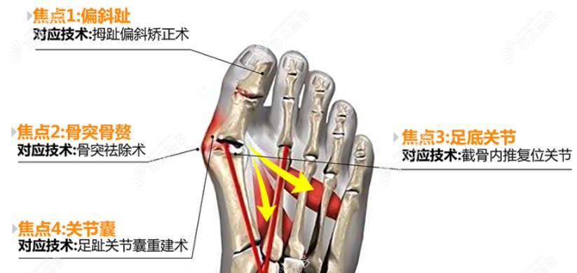 微创大脚骨手术过程融合的技术示意图