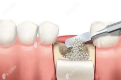 种植牙骨粉骨膜作用，看植牙填骨粉骨膜对身体有什么影响