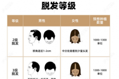看男女头顶脱发等级划分图,研究植发五千个单位是几级脱发