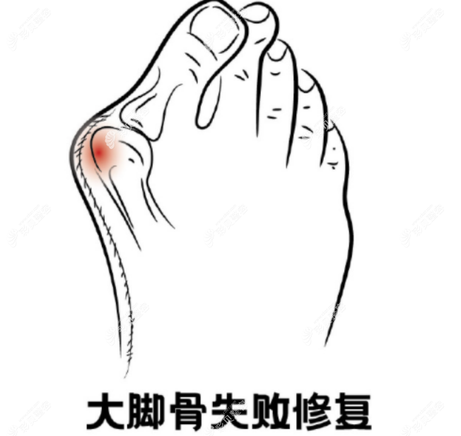 大脚骨手术