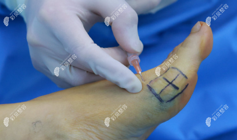 大脚骨手术