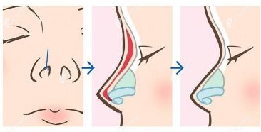 宁波薇琳鼻子眼睛哪个医生做的好？眼鼻综合好的医生名单