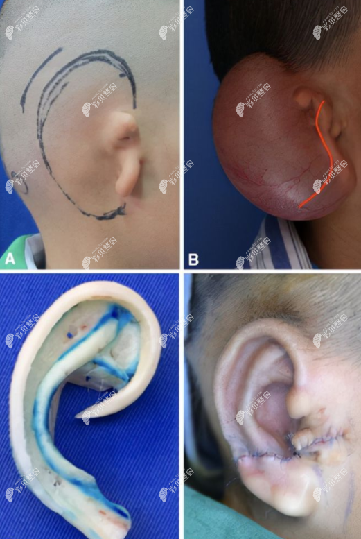 耳再造扩张法的手术流程