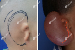 耳再造直埋和扩张哪个好一点，小耳再造直埋法的优缺点是..