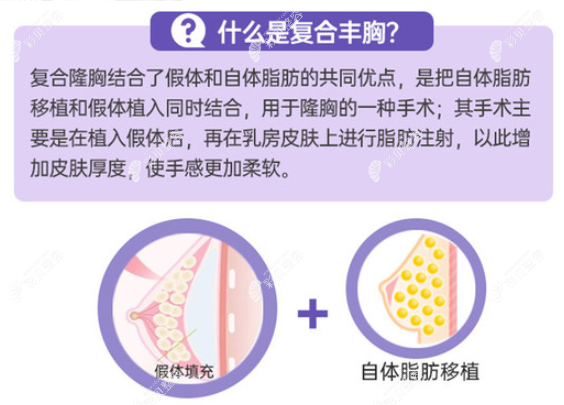 郭杰医生做复合隆胸的原理