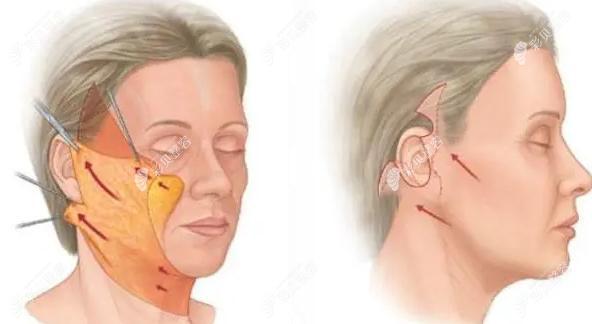 PSV面部提升手术过程示意图 PSV面部提升手术过程示意图