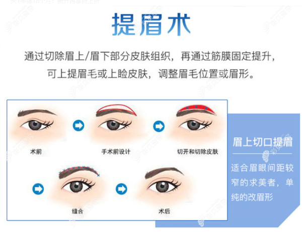 切眉手术的原理