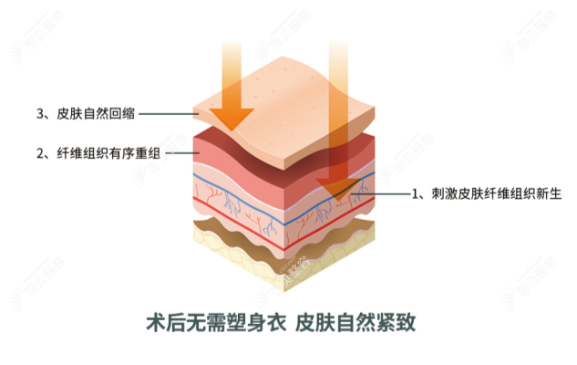 土麦森吸脂真的可以不用穿塑身衣