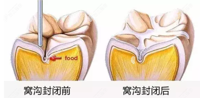 牙齿做窝沟封闭前后对比