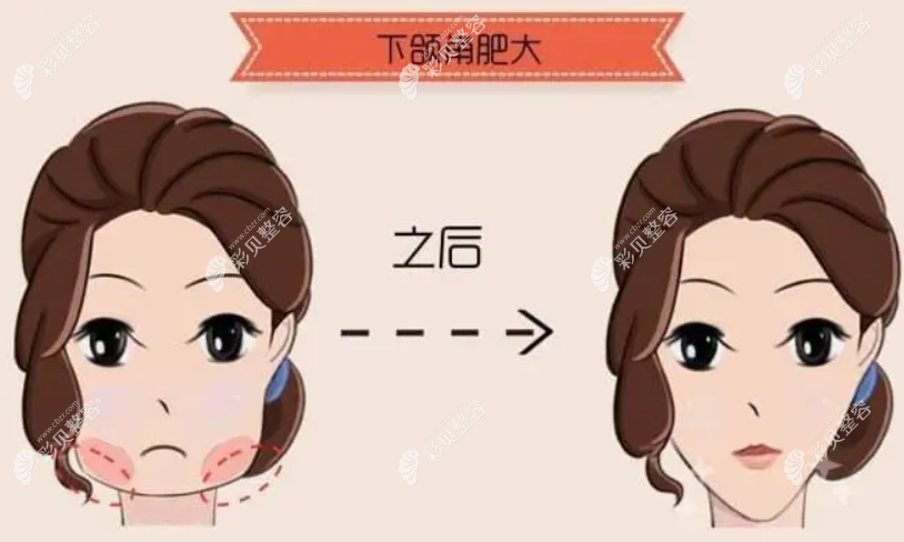 四十岁人做磨骨改脸型术前后变化图