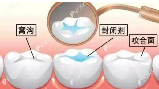 儿童牙齿做窝沟封闭的情况