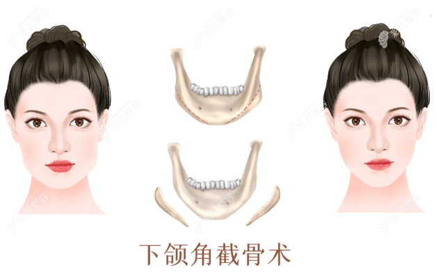 40岁女人还可以做磨骨削骨手术吗