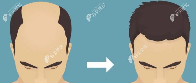 植发前后对比图