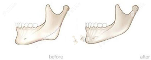 磨骨手术前后对比