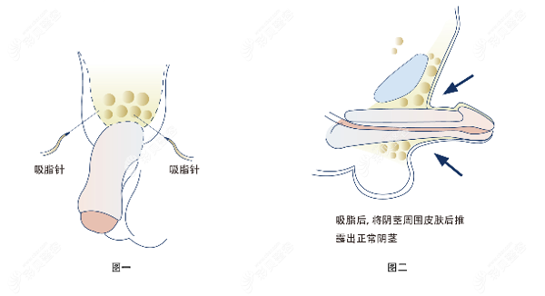 gpmax延长术图解图片