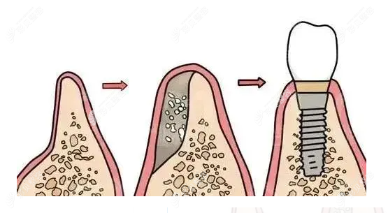种植牙填骨粉的作用