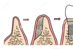 种植牙放骨胶原还是骨粉好,骨胶原蛋白和骨粉的区别了解下