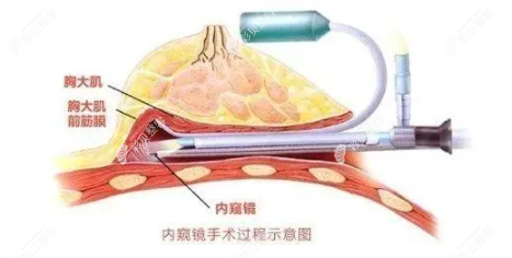 内窥镜假体隆胸图解