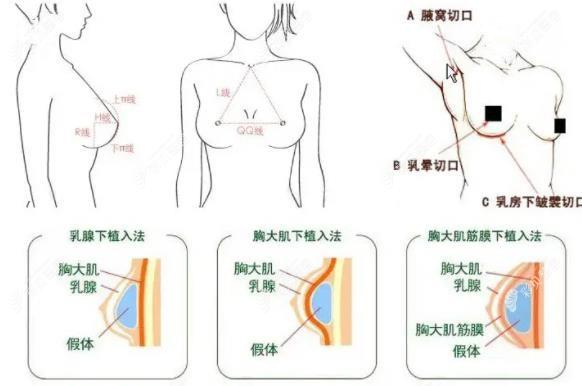 假体隆胸三种切口位置图解