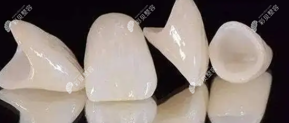 全瓷牙冠 全瓷牙冠